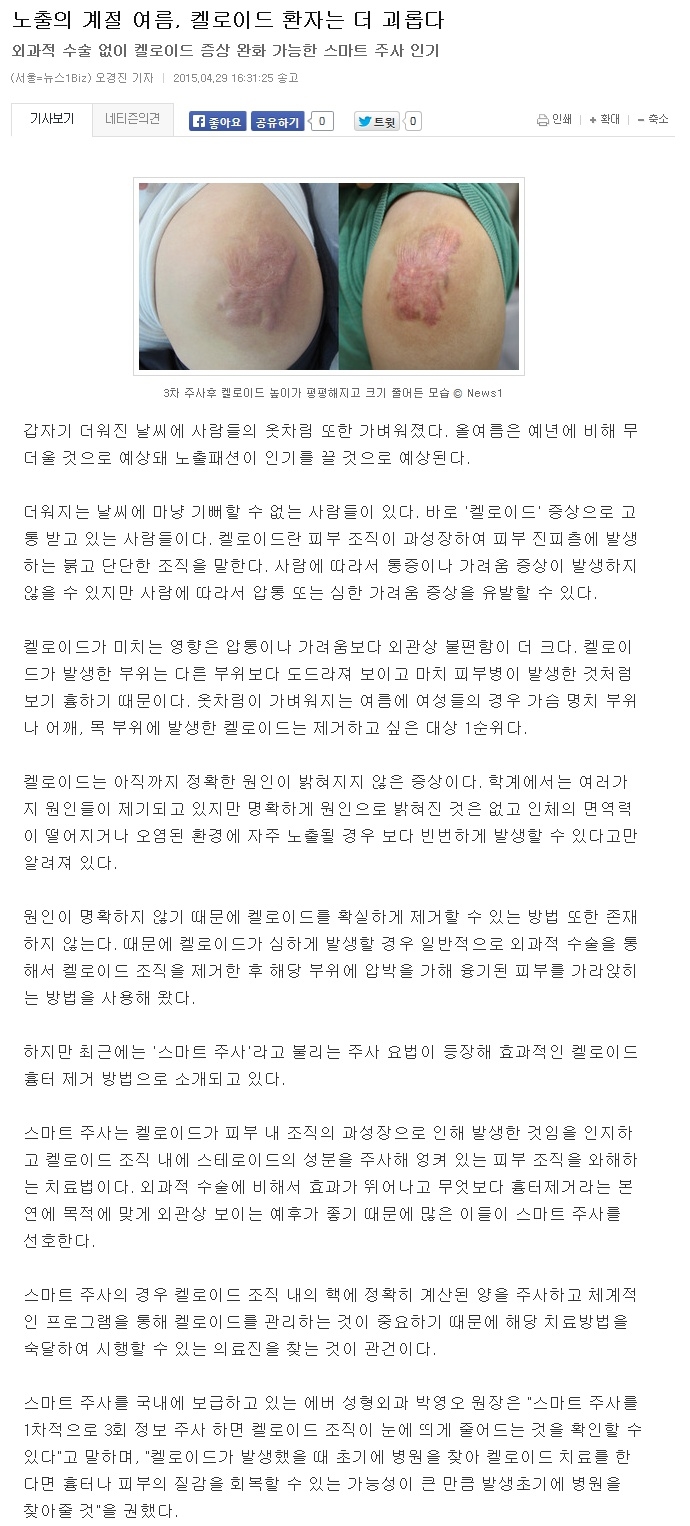 노출의 계절 여름, 켈로이드 환자는 더 괴롭다.