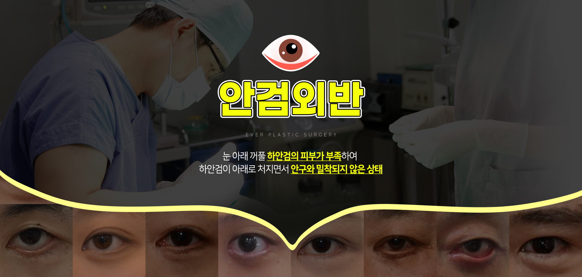 안검외반