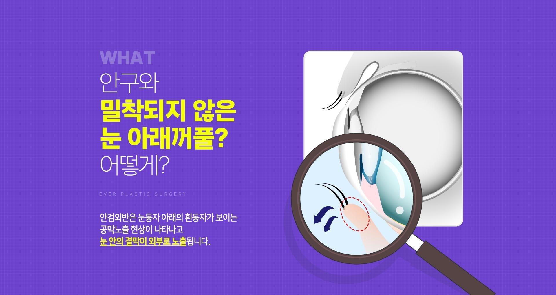 안구와 밀착되지 않은 눈 아래꺼풀