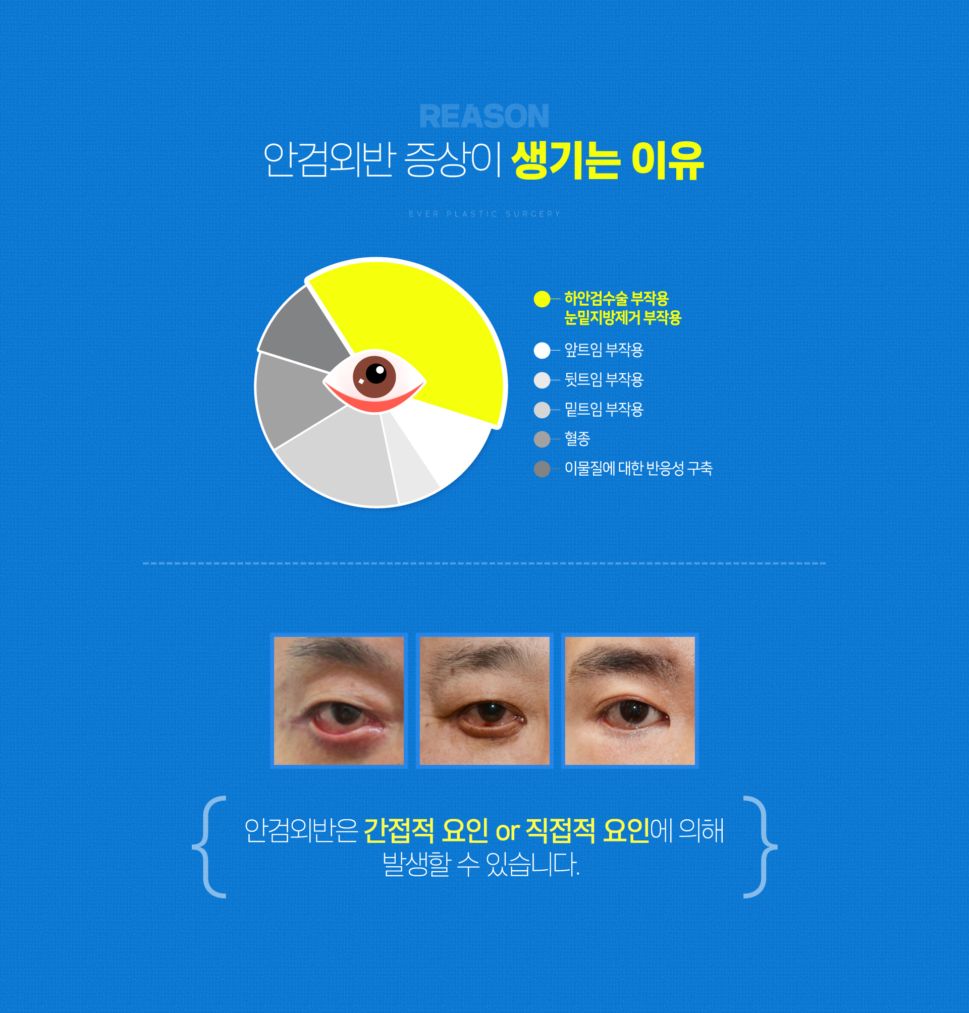안검외반 증상이 생기는 이유