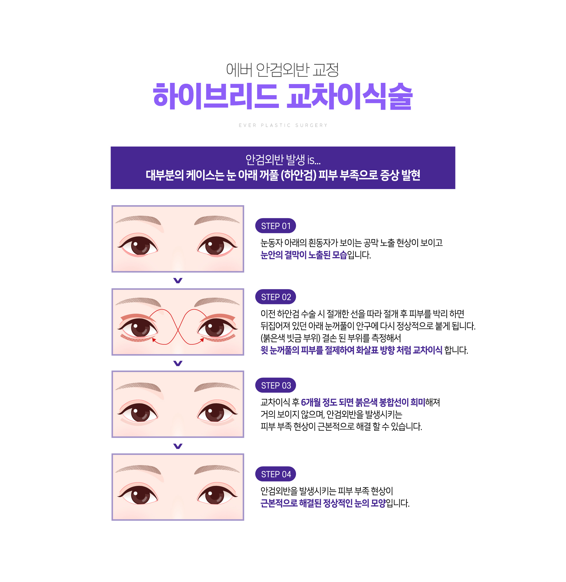 하이브리드 교차이식술