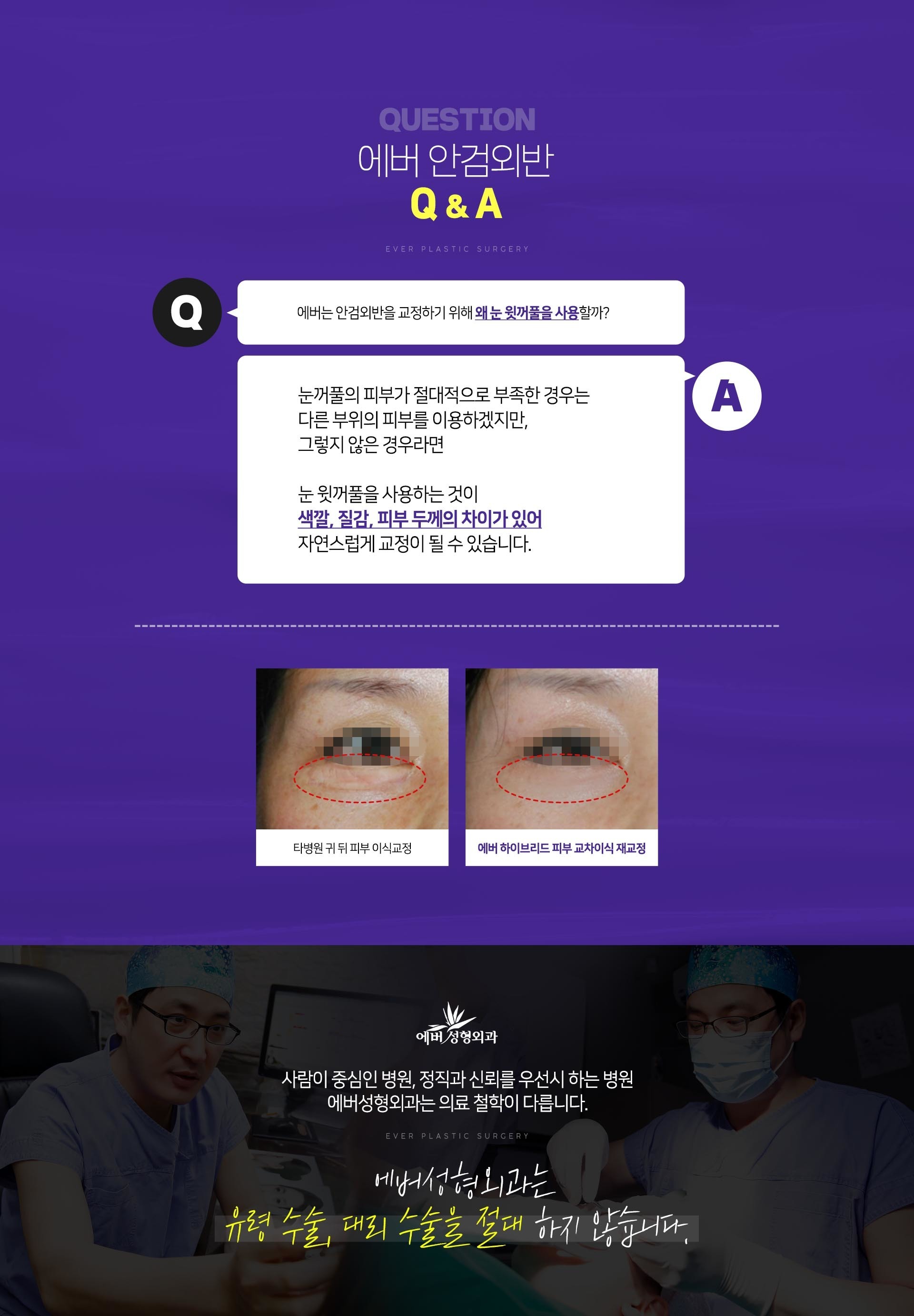 에버 안검외반 Q&A