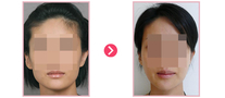 사각턱