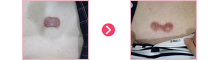 가슴켈로이드 (가슴피지선제거)