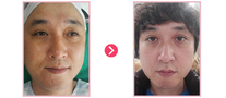 안검황색종