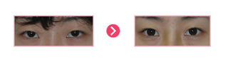 뒷트임, 눈매교정