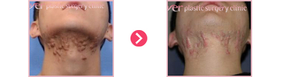 턱켈로이드의 치료