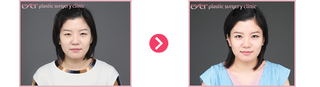 여자의 안검하수