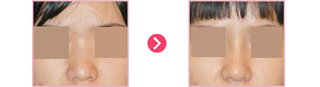 융비술