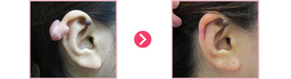 귀켈로이드 (3개월경과)