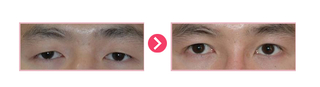 안검하수