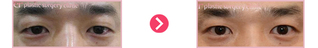 안검하수교정