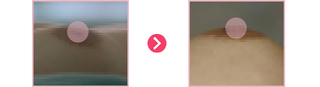 함몰유두
