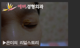 안검황색종+상안검성형술